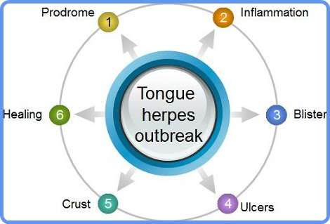 Herpes on tongue cure - stages of outbreak