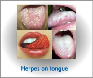 Herpes on tongue cure