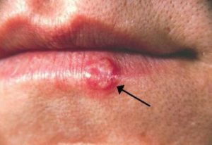 Human herpes virus cold sores