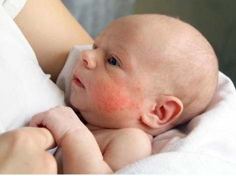 Baby with herpes on his face - Kill herpes virus