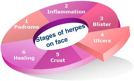 Herpes on face treatment - Stages
