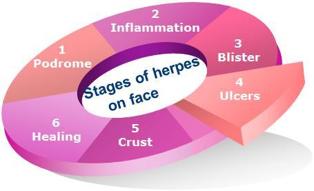 Herpes on face treatment How to cure facial herpes definitively 