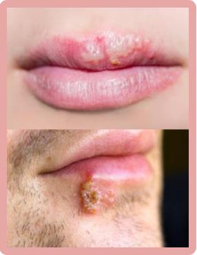 Herpes on face treatment