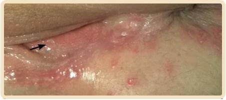 How to get rid of genital herpes fast