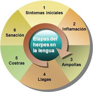 Herpes en la lengua - Etapas