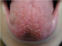  Herpes en la lengua - Foto