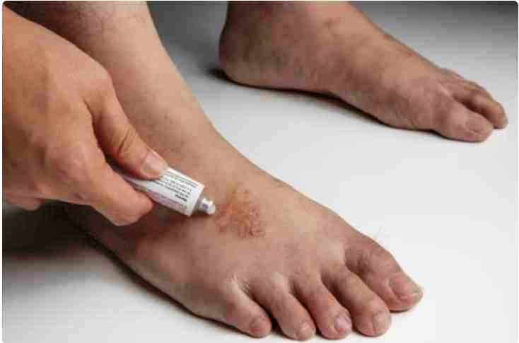 Herpes circinado en el pie
